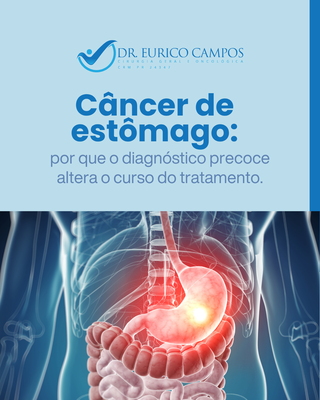 Como funciona o tratamento cirúrgico do câncer digestivo: do diagnóstico à recuperação