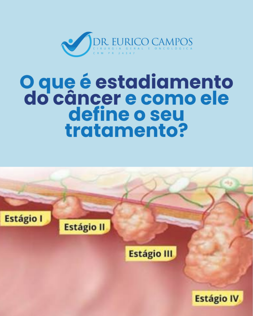 O que é Estadiamento do Câncer e Como Ele Define o Tratamento