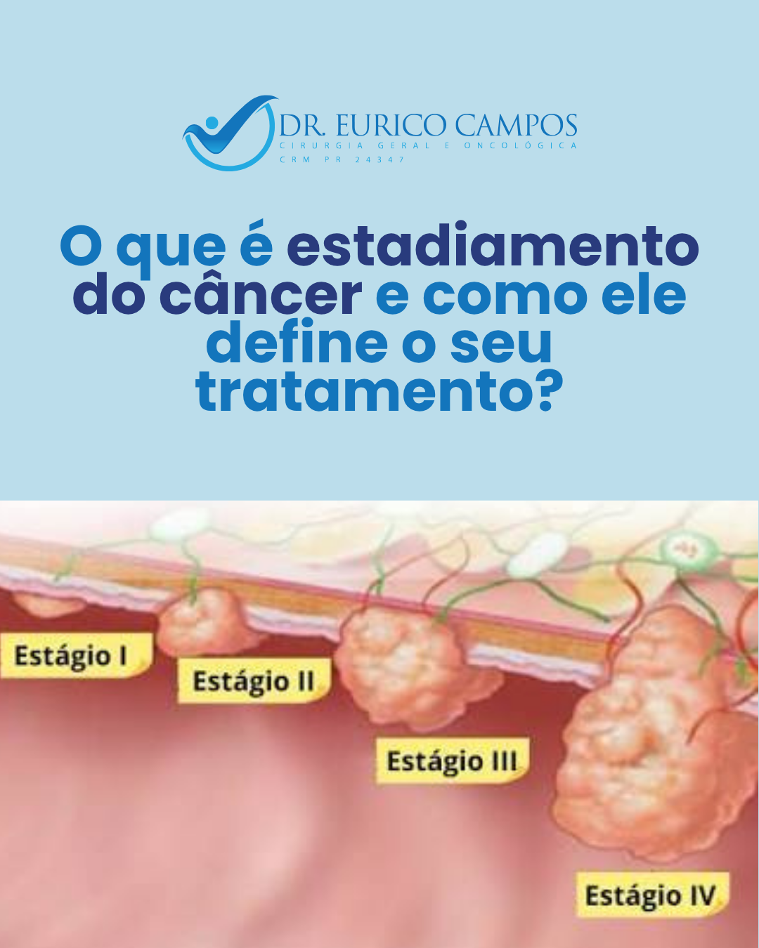 O que é Estadiamento do Câncer e Como Ele Define o Tratamento