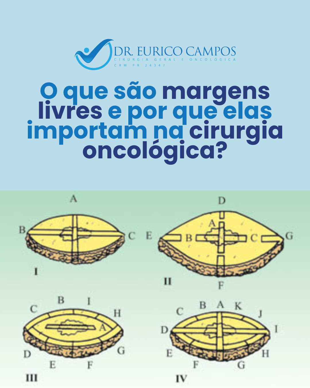 O que são margens livres e por que elas importam na cirurgia oncológica?